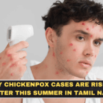 Why Chickenpox Cases Are Rising Faster This Summer in Tamil Nadu