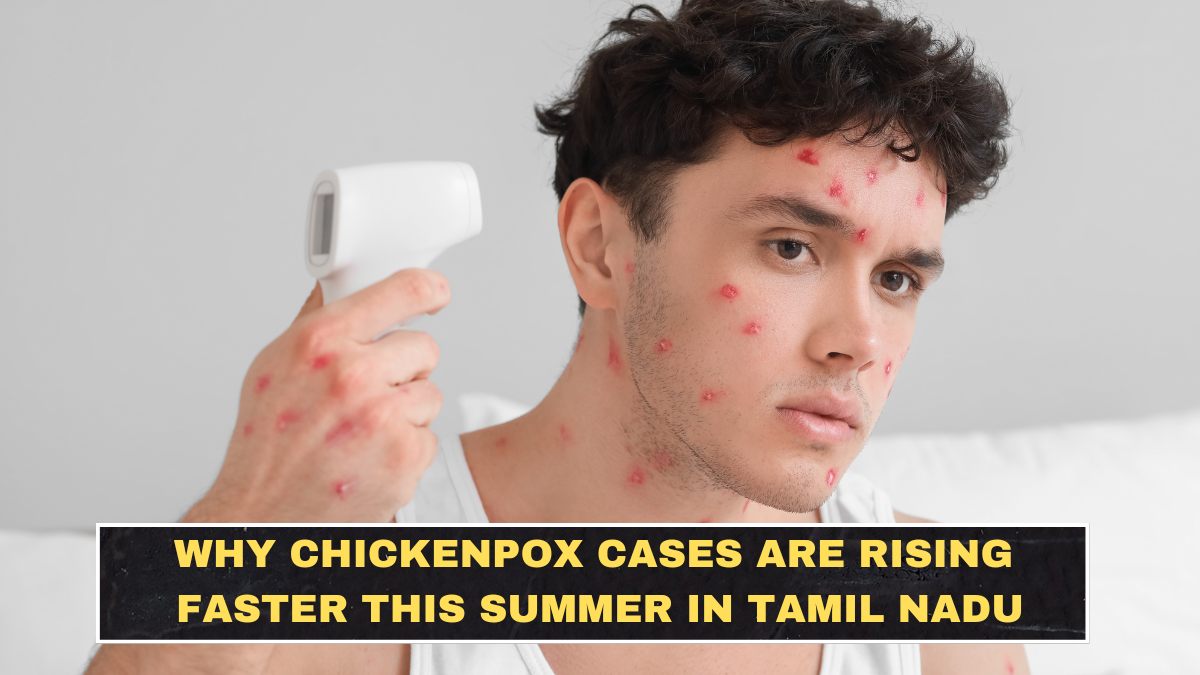 Why Chickenpox Cases Are Rising Faster This Summer in Tamil Nadu